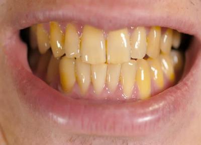 مصرف کدام خوراکی ها منجر به زرد شدن دندان ها می گردد؟